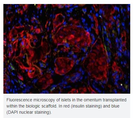 The best place to treat type 1 diabetes might be just under your skin